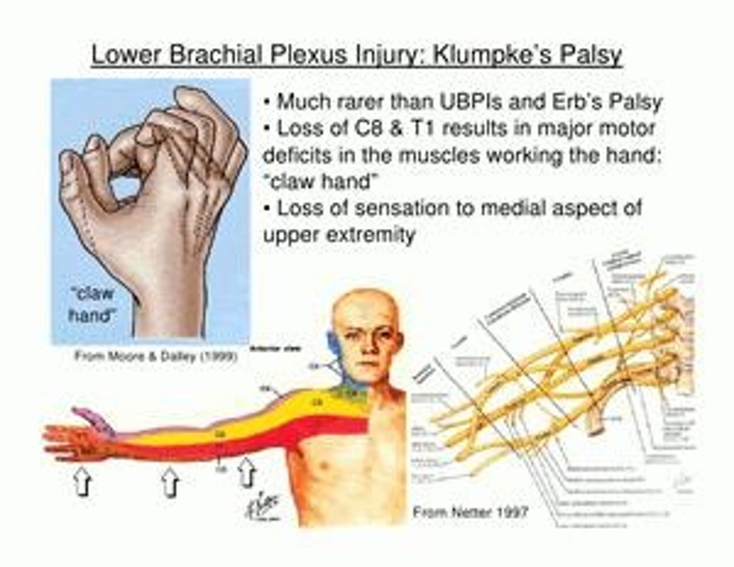 <p>A brachial plexus injury affecting C7-T1 nerves, often resulting in claw hand.</p>