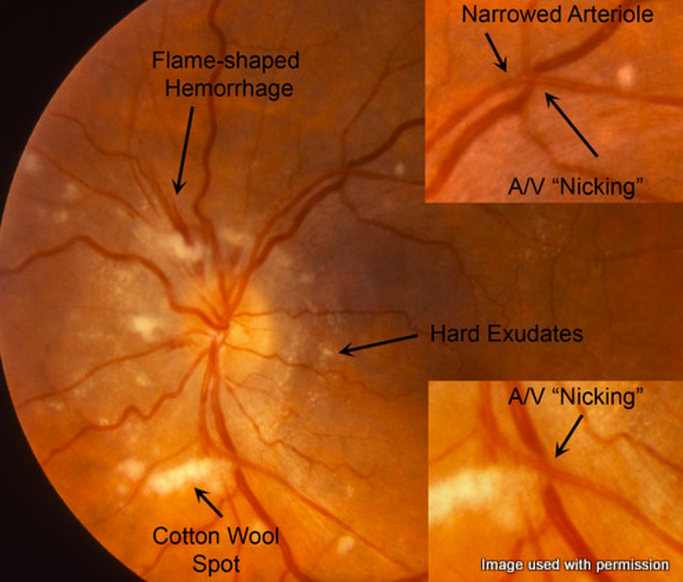 <p>It is usually asymptomatic until late in the disease course, but patients may experience cloudy vision, diplopia, headaches, and eventual vision loss.</p>
