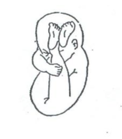 <p>vaginal delivery possible but c/s recommended; <strong>hips are flexed and knees extended</strong>, so the feet are near the head; <strong>buttocks are presenting</strong>; most commo</p>