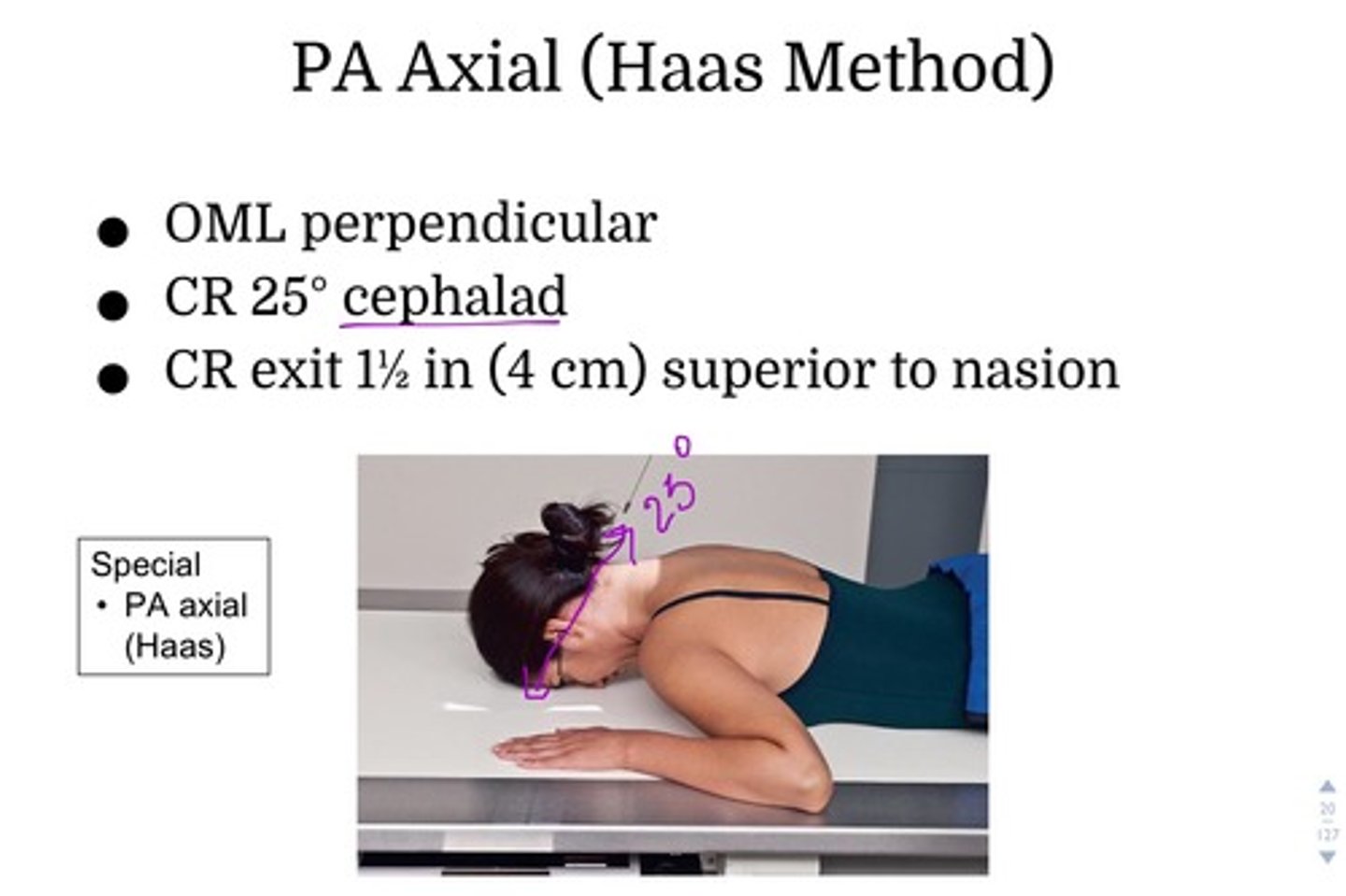 <p>25 degrees cephalad</p>