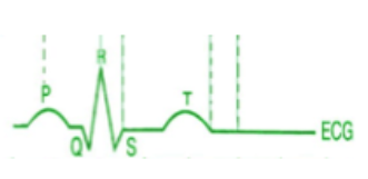 <p>what does the QRS complex indicate on an EKG?</p>