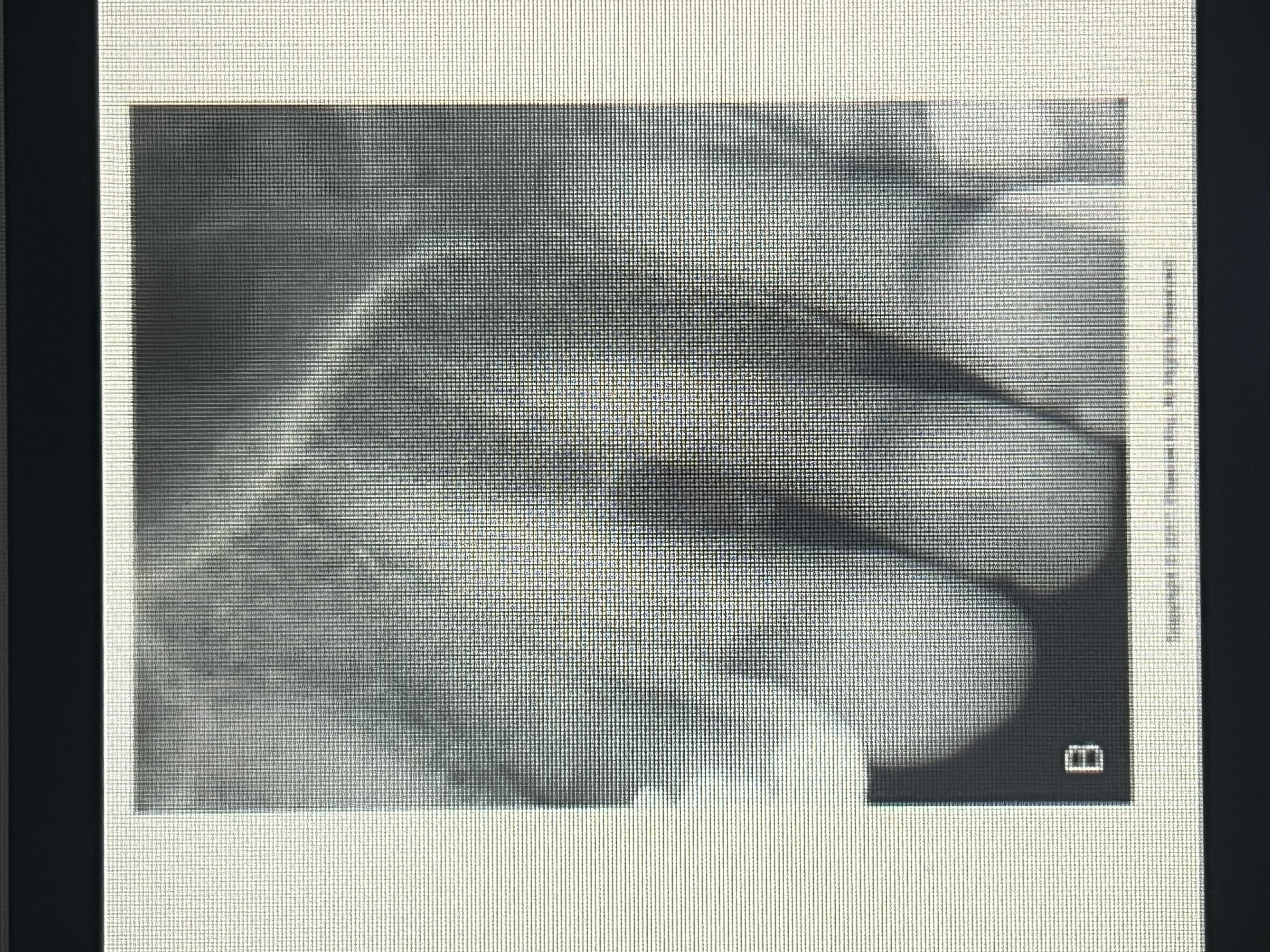 <p>A lesion located between the roots of adjacent teeth.</p>