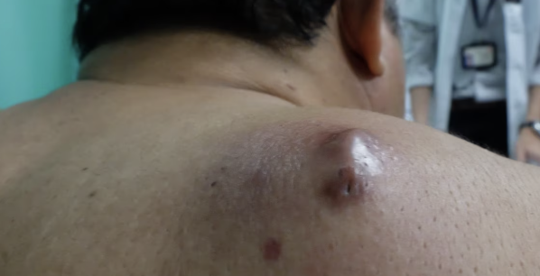 <p>what type of raised, fluid-filled, primary skin lesion is this?</p>