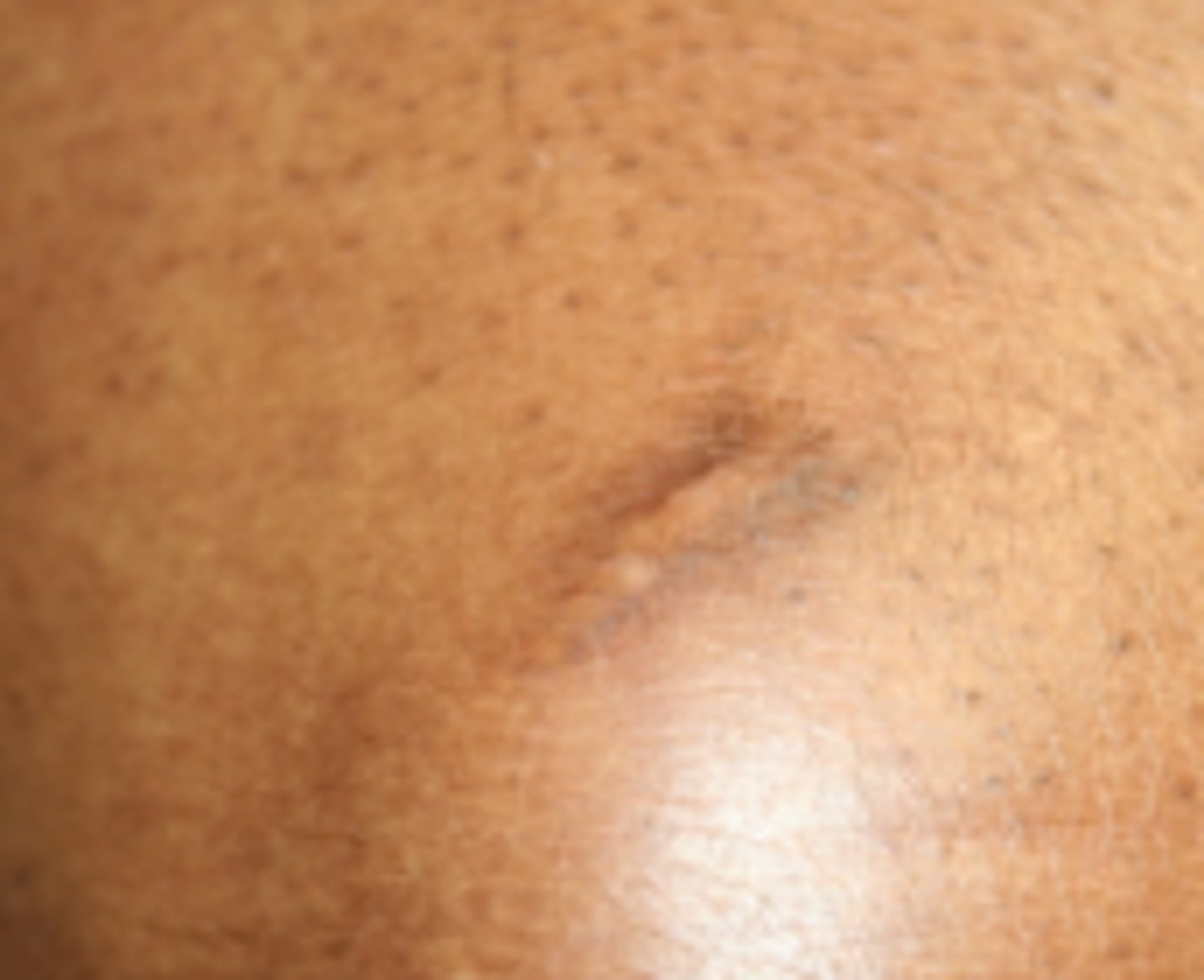<p>darkened pigmentation due to an injury</p>