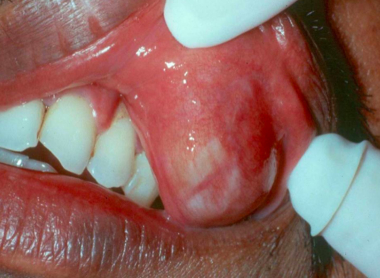 <p>What common salivary gland tumor is at risk of undergoing malignant transformation?</p>