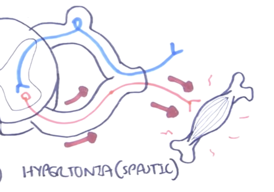 <p>A <strong>continuously firing efferent neuron</strong> with <strong>no inhibition</strong> continuously stimulates the muscle</p>