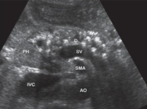 <p>The patient has on their chart that they consume alcoholic beverages daily. When an US was performed, this was seen at the pancreas. What is can be assumed here?</p>
