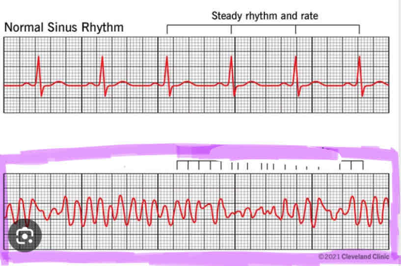 <p>a heart condition that causes an irregular and often abnormally fast heart rate</p>