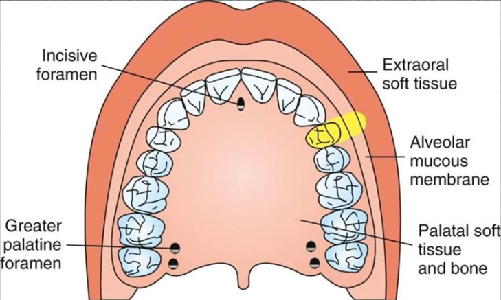 <p>Most frequently used for pulpal anesthesia in maxillary teeth → but used when only 1-2 teeth are being treated</p><ul><li><p>Areas anesthetized: crown, root, pulp, periodontium</p></li><li><p>Contraindication: Acute inflammation to the area or dense bone on top of tooth</p></li><li><p>Very high success</p></li><li><p>Armamentarium recommendations: 27 gauge, short needle, bevel towards bone</p></li><li><p>Technique: Inject at height of mucobuccal fold about the apex of the tooth, bevel down</p></li><li><p>Amount of anesthetic: 0.6ml</p></li></ul><p></p>