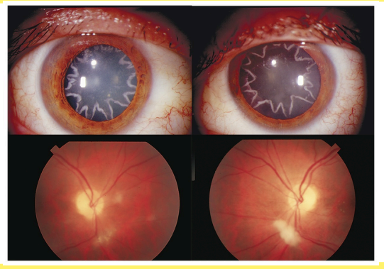 <ul><li><p>Cataracts</p></li><li><p>Macular holes</p></li></ul><p></p>