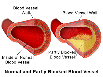 <p>b) Thickening and loss of elasticity of arterial walls</p>