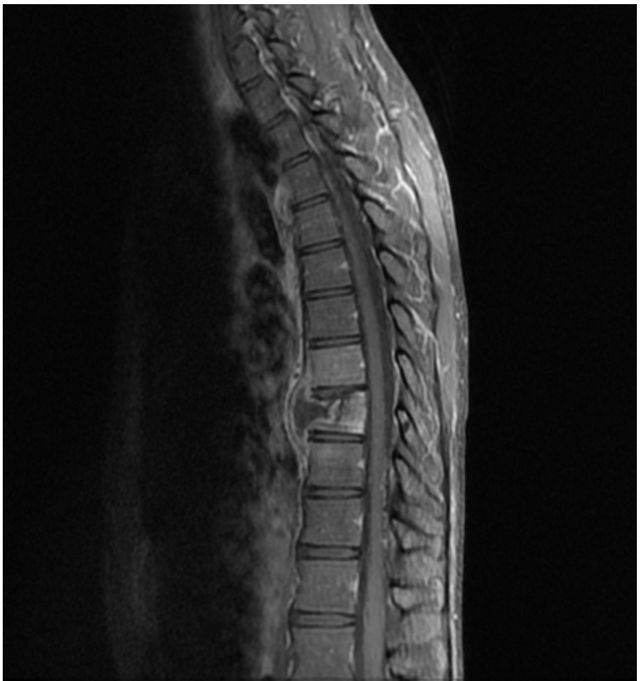 <p>TB in the skeleton (particular the vertebrae) that causes back pain and deformity</p>