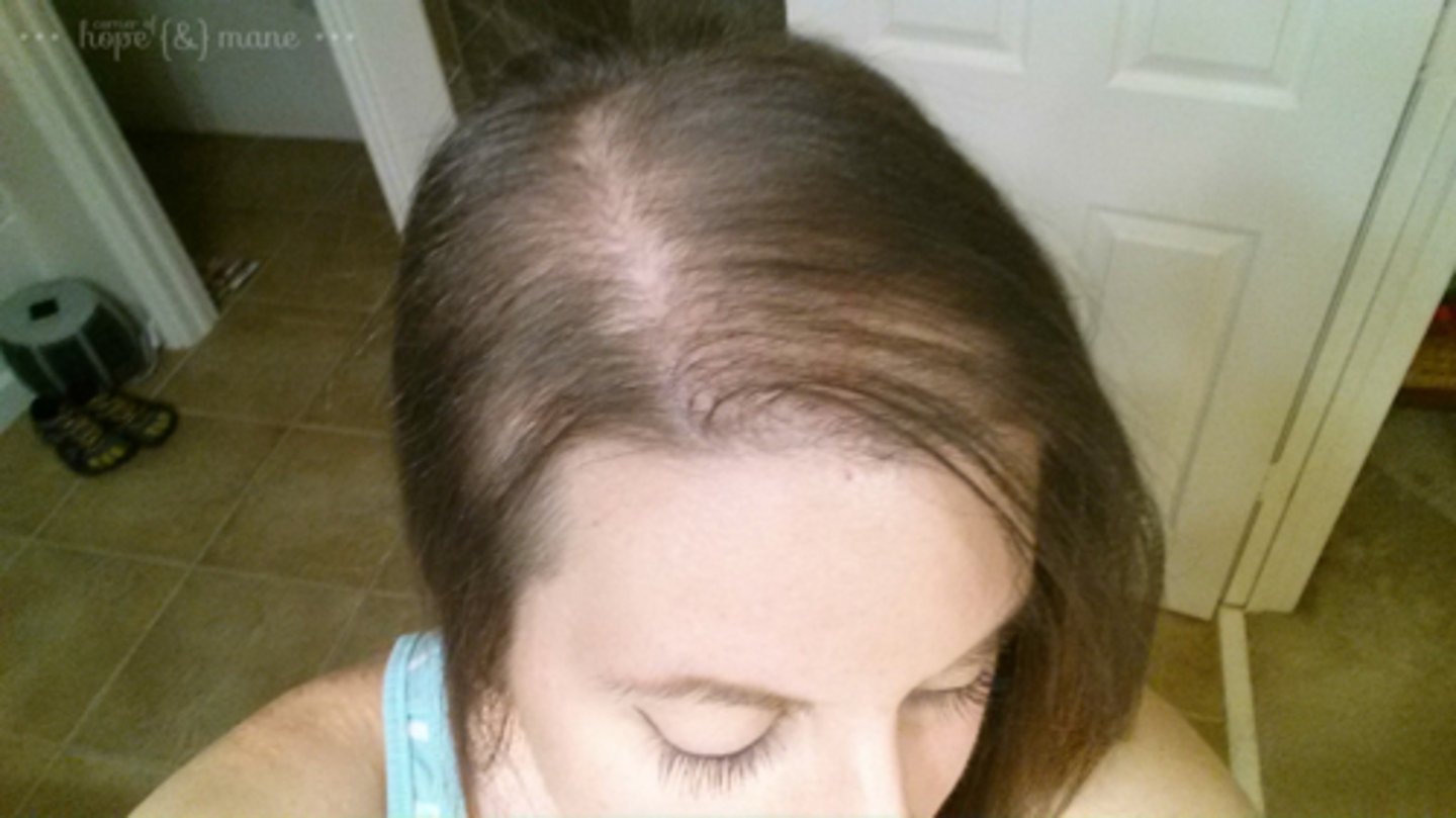 <p>temporary hair loss experienced at the conclusion of a pregnancy.</p>