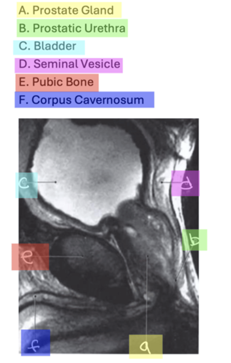 <p>A. Prostate Gland</p><p>B. Prostatic Urethra C. Bladder</p><p>D. Seminal Vesicle</p><p>E. Pubic Bone</p><p>F. Corpus Cavernosum</p>