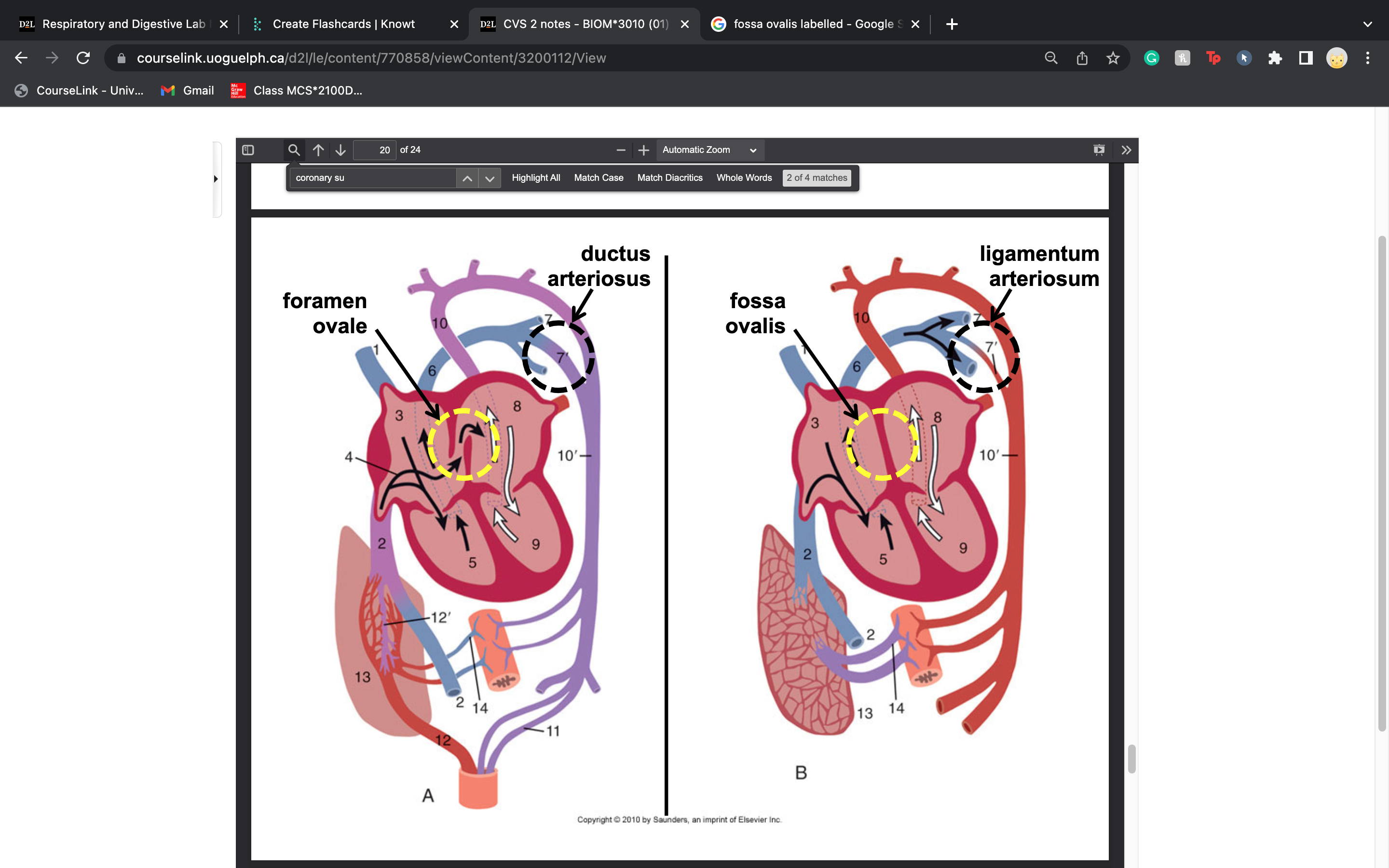 ductus arteriosus is a normal fetal artery connecting the main body artery (aorta) and the main lung artery (pulmonary artery)
CLOSES UP IN THE MONTHS AFTER BIRTH to become the ligamentum arteriosum