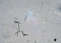 <p>What is this crystal? what disease is it associated with? what is its pH? normal or abnormal?</p>