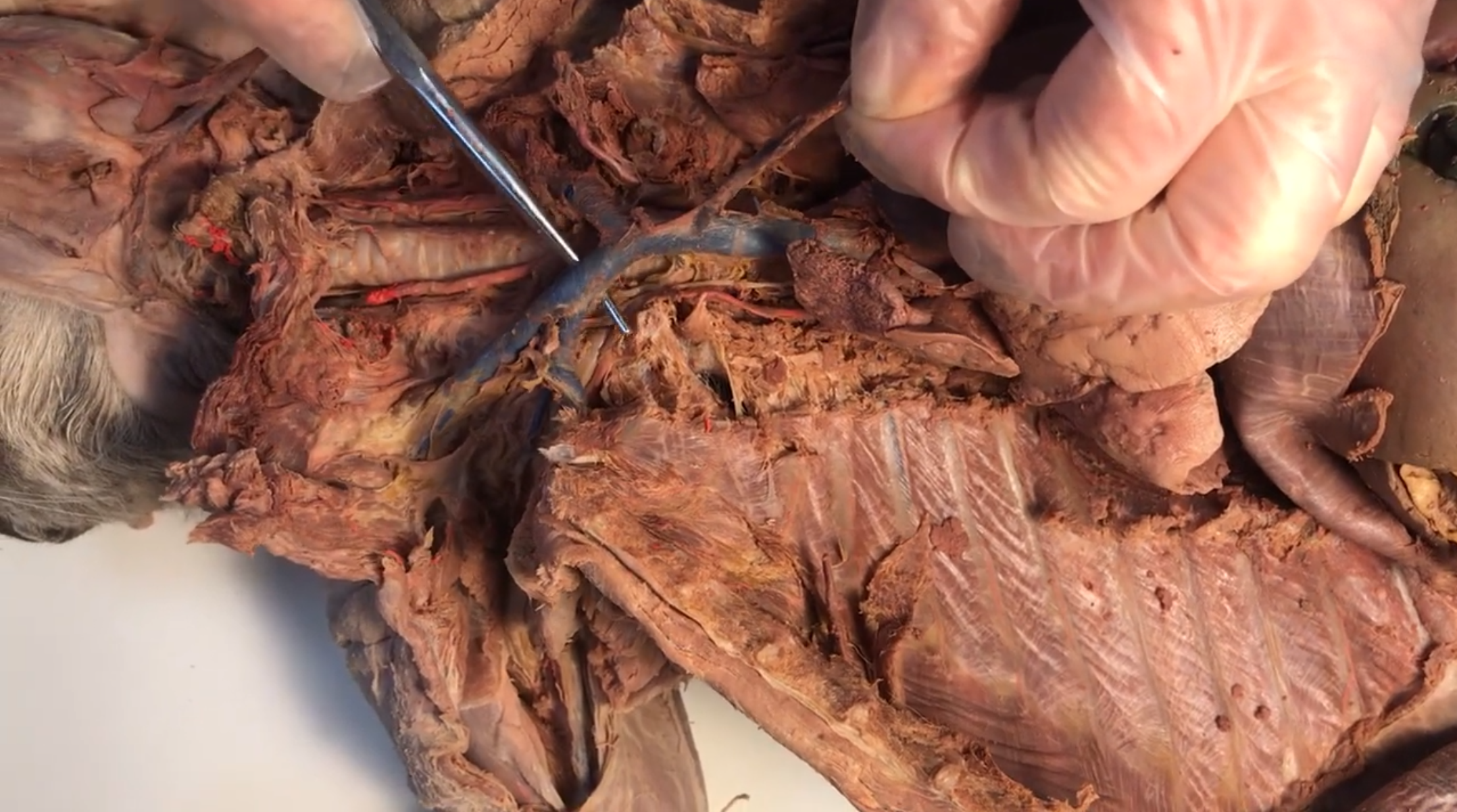 <p>What vein is this</p>