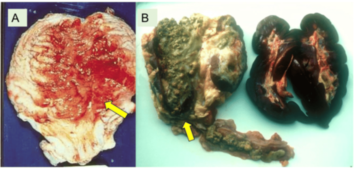 <p>1. Commensals of the vagina + Prepuce, Infectious</p><p>2. Most common in multiparous, post parturient cows</p><p>3. Bacteria spreads so cattle get infections in bladder → Urinary Tract → Kidneys</p><p>4. Causes Uraemia, Renal failure</p><p>5. Confirmed by blood biochemistry (High Urea and creatinine Levels)</p><p>6. If not in renal failure, treat with penicillins</p>