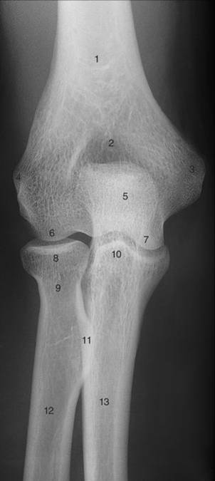 The aspect of bone identified as 11 in the figure above is the: