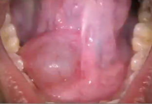 <p>mucocele on the floor of the mouth </p>