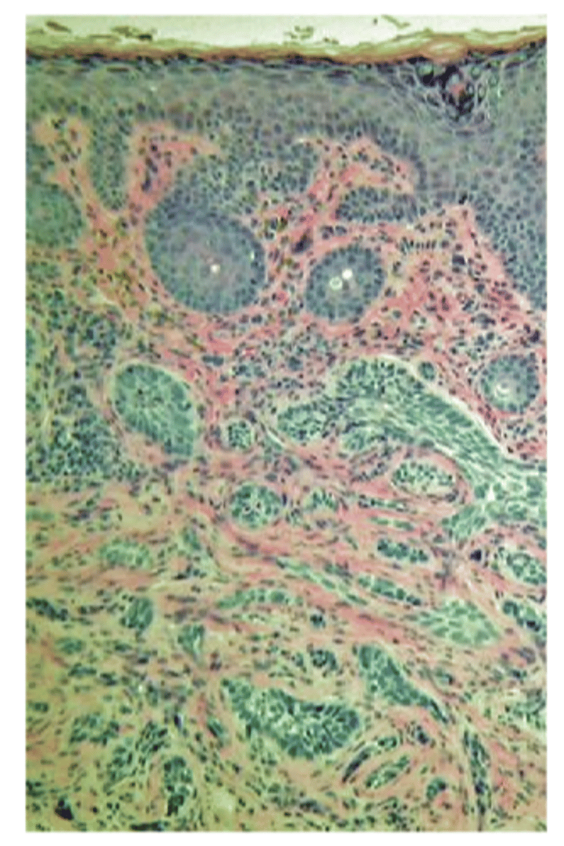 <p>proliferation of epidermal basal cells that form tumor tissue in the form of: </p><p>strands </p><p>chords</p><p>islands packed with dense fibrous tissue seen in morpheaform (can be challenging to get full excision)</p>