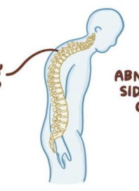 <p><mark data-color="yellow"><u><strong>What is exaggerated thoracic curvature called?</strong></u></mark></p>