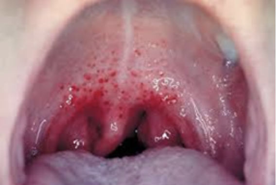 <ul><li><p><span>How would you document the red spots found in this patient’s mouth?</span></p></li></ul><ul><li><p><span>How would you grade these tonsils?</span></p></li></ul><p></p>