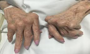 <p><strong>Rheumatoid Arthritis: Signs and Symptoms</strong></p><p>-____________, polyarticular disease with ______ onset. Classically affects the ___, ___, MTP joints, and wrists (usually spares the ___ joints) </p><p>-Joint ____</p><p>-Joint stiffness → morning stiffness _ 30-60 minutes, improves with activity </p><p>-"_______” joint swelling (synovitis) → much more inflamed than in osteoarthritis </p>