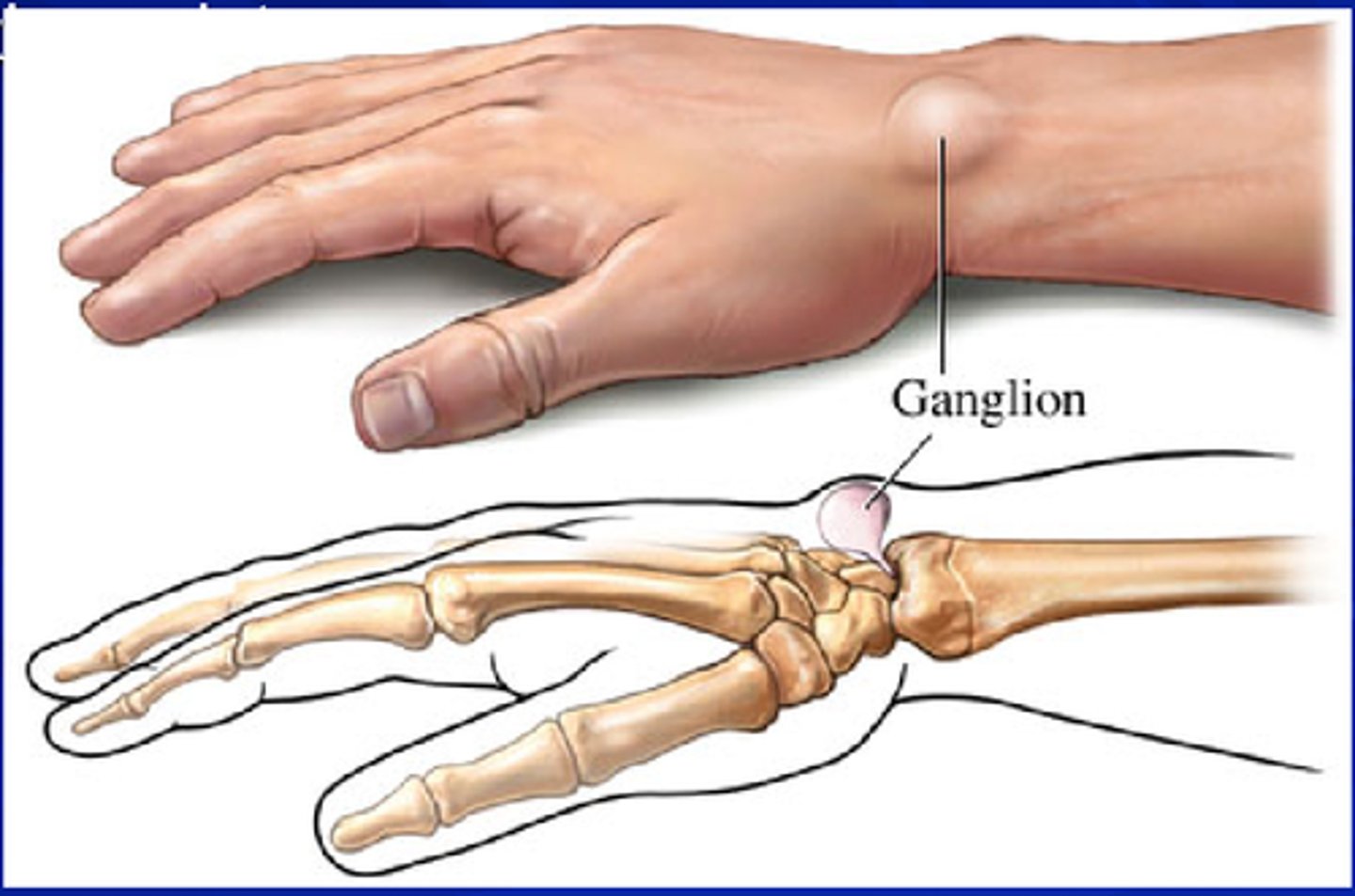 <p>Ganglion cyst</p>