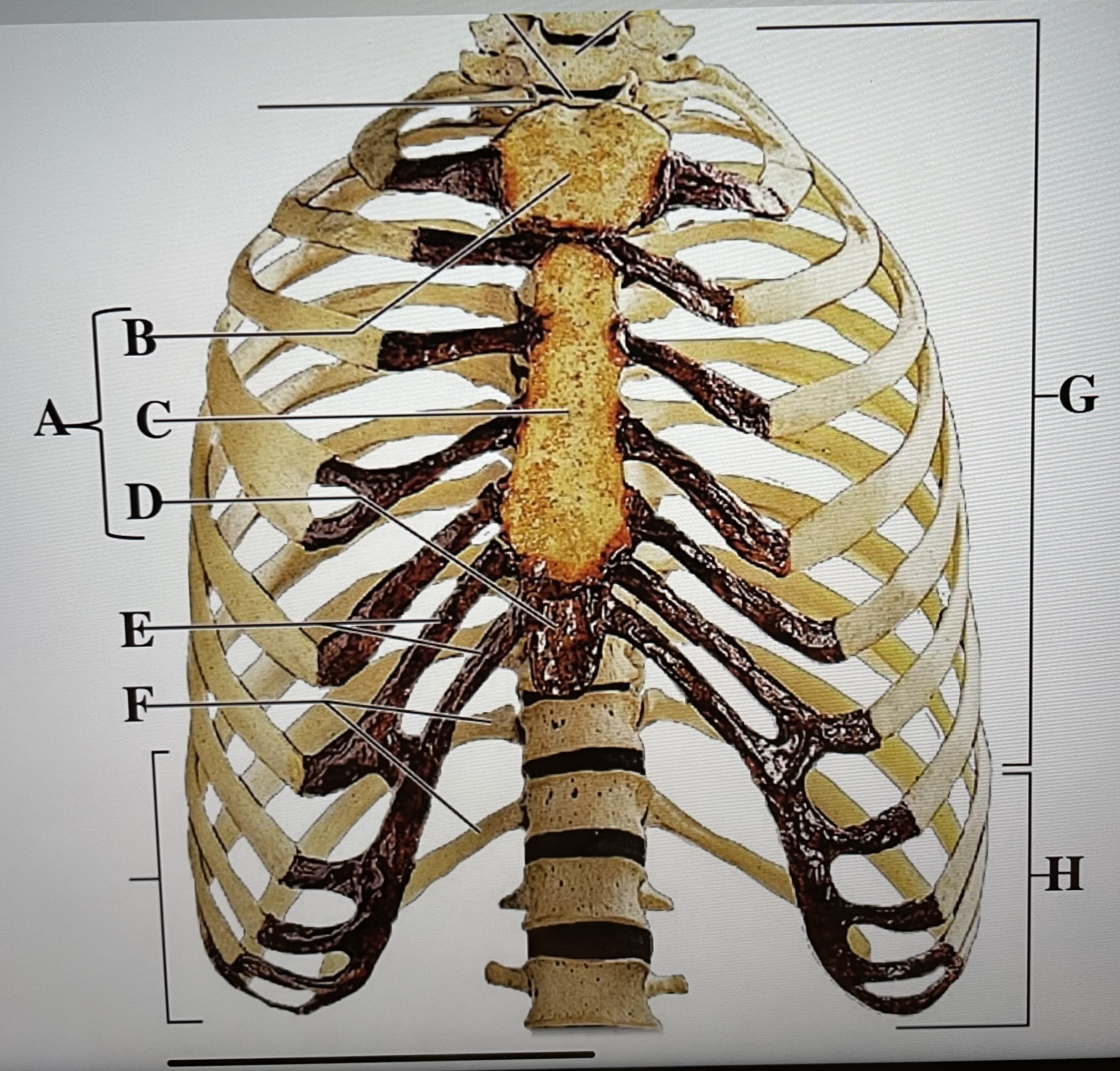 In the figure above,  *are the false ribs and* _ is the manubrium 