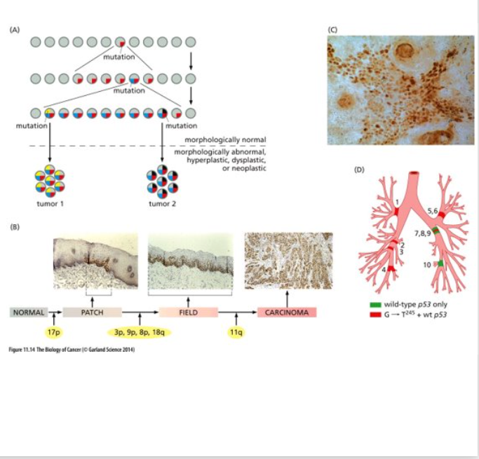 <ul><li><p class="Paragraph WhiteSpaceCollapse  BCX0 SCXP201597939" style="text-align: left"><span>Large area of histologically normal but genetically altered epithelium can sprout multiple, seemingly independent foci of neoplastic cells all of which carry the mutations common to this area as well as subsequently acquired mutants that are unique to each focus​</span></p></li><li><p class="Paragraph WhiteSpaceCollapse  BCX0 SCXP201597939" style="text-align: left"><span>(A) represents one model of <strong>field cancerization = occurrence of genetic and epigenetic alterations in histologically normal- appearing tissues -- leads to an increased risk for the development of tumors; the presence of cells with genetic mutations adjacent to the tumor</strong>​</span></p></li><li><p class="Paragraph WhiteSpaceCollapse  BCX0 SCXP201597939" style="text-align: left"><span>(B) p53 mutant cells are detected in normal patches of the oral epithelium, as tumor progression continues larger fields can be found (still histologically normal) (yellow indicates LOH); several fields progress into carcinomas (last panel)​</span></p></li><li><p class="Paragraph WhiteSpaceCollapse  BCX0 SCXP201597939" style="text-align: left"><span>(C) p53 mutated keratinocytes found in sun exposed human skin – histologically normal​</span></p></li><li><p class="Paragraph WhiteSpaceCollapse  BCX0 SCXP201597939" style="text-align: left"><span>(D) Post-mortem analysis of presence of p53 mutations (same rare somatic mutation); widespread in the lung, carcinoma did not develop in this case​</span></p></li></ul><p></p>