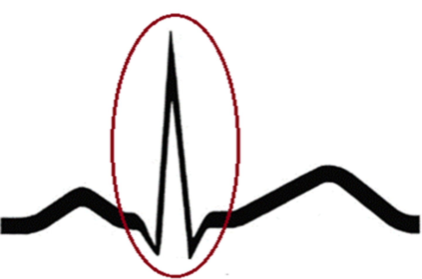 <p>ID the EKG Deflection</p>