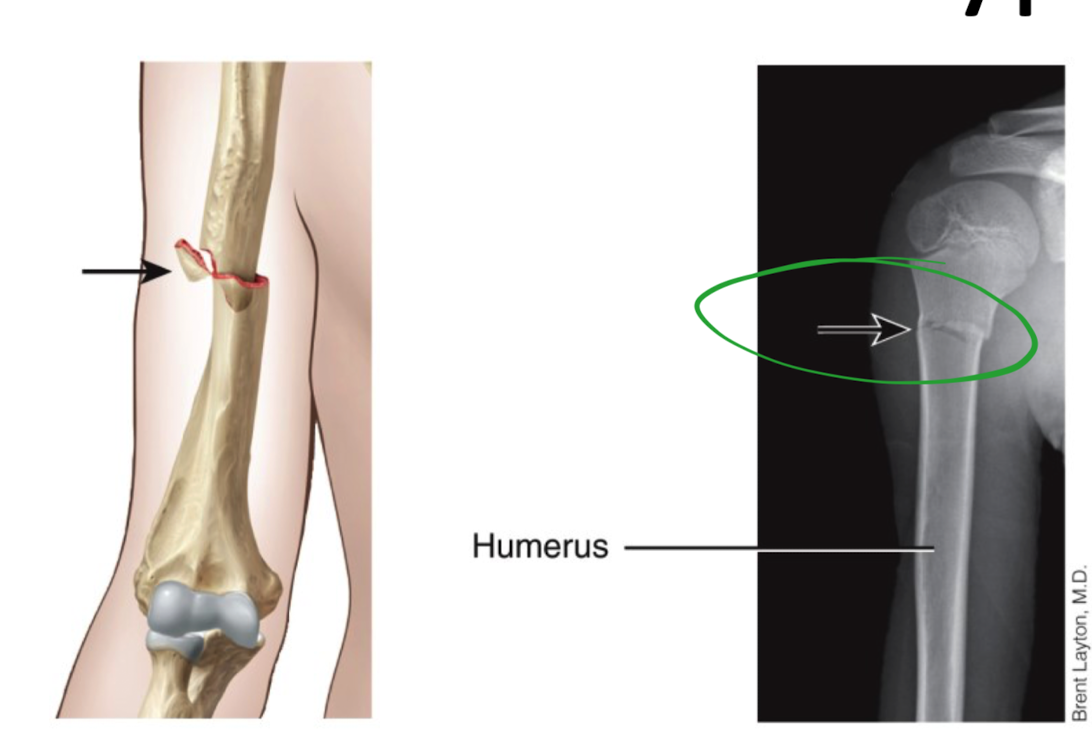 <ul><li><p>in humerus </p></li><li><p>one end of the bone is forcefully driven into other end of bone </p><ul><li><p>“Jamming motion”</p></li></ul></li></ul>