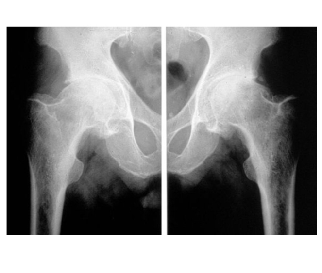 <ul><li><p>pincement supéro-externe de l’interligne coxo-fémorale bilatérale </p></li></ul><p></p>