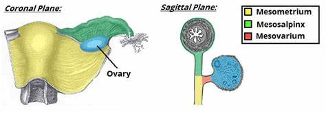 <p>lies in the mesosalpinx:</p><p>A. ovarium F</p><ul><li><p>ovary is attached to the <strong>mesovarium</strong>, not the mesosalpinx</p></li></ul><p>B. a. vaginalis F</p><ul><li><p>artery to the vaginalis is not a main structure in the mesosalpinx</p></li></ul><p>C. uterine tube T</p><p>D. lig. teres uteri ( round lig ) F</p><ul><li><p>round ligament passes through the <strong>broad ligament</strong> but is not within the mesosalpinx</p></li></ul><p>E. uterus F</p><ul><li><p>uterus is supported by the broad ligament but is not within the mesosalpinx</p></li></ul><p></p>