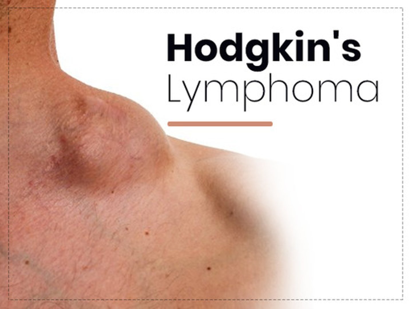 <p>Definition: Tumor that originates in ONE single lymph nodes --&gt; spread to other nodes</p>