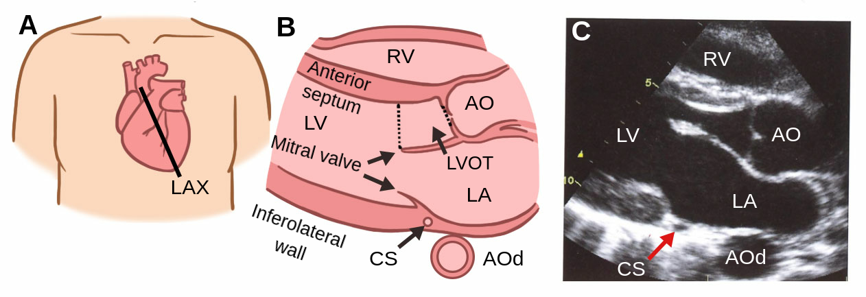Parasternal long axis view, this is where the heart is sliced vertically.