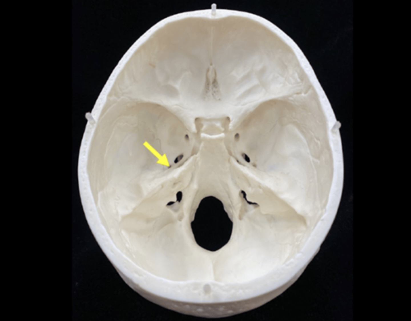 <p>name the bone and bone feature</p>