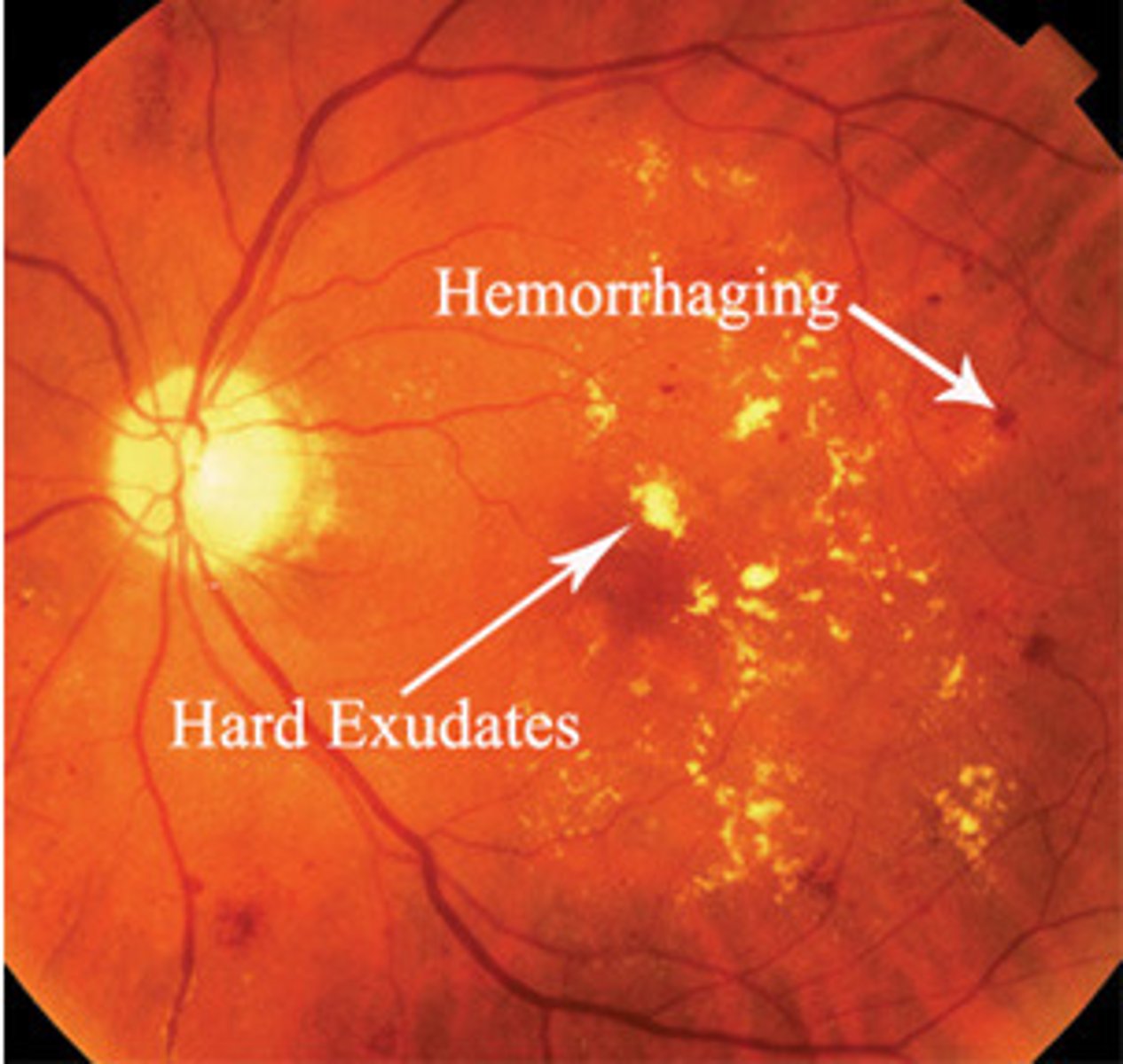 <p> <u>Risk Factors</u>: DM patient w/retinal changes w/ or w/o vision loss,  any age, <strong>leading cause of blindness in the world</strong></p><p><u>S&amp;S</u>: <strong><u>nonproliferative</u></strong>: <strong><mark data-color="#fffb00" style="background-color: #fffb00; color: inherit">cotton wool spots, hard exudates</mark></strong> (yellowish)</p><p><strong><u>proliferative</u></strong>: <strong>neovascularization</strong>, vitreous <strong>hemorrhage</strong>, possible retinal detachment</p><p><u>Complications</u>: Cataracts &amp; Blindness</p><p><u>Tx</u>: must have annual eye exam w/ fundoscopic exam every visit, PCP control DM, HTN, hyperlipidemia, preserve renal function, vision change = emergent</p>