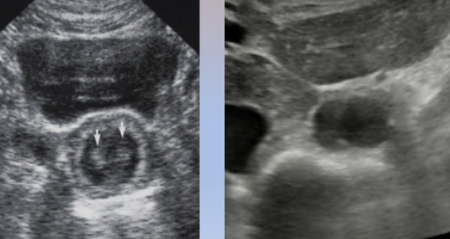 <ul><li><p><span style="background-color: transparent;">AKA Duplication or Ghost Artifact</span></p></li><li><p><span style="background-color: transparent;">Change in beam direction when the beam encounters a boundary between two materials with different propagation speeds</span></p></li><li><p><span style="background-color: transparent;">Causes object to be projected laterally</span></p></li><li><p><span style="background-color: transparent;">Appears as:</span></p><ul><li><p><span style="background-color: transparent;">Widening (of object)</span></p></li><li><p><span style="background-color: transparent;">Duplication (of object)</span></p></li></ul></li><li><p><span style="background-color: transparent;">Can be reduced by sliding the transducer laterally</span></p><ul><li><p><span style="background-color: transparent;">Happens quite frequently at the midline of the body, especially in the abdomen, because of the rectus abdominis muscles</span></p></li><li><p><span style="background-color: transparent;">This often affects the aorta in transverse, so you would just slide the transducer laterally</span></p></li></ul></li></ul><p></p>