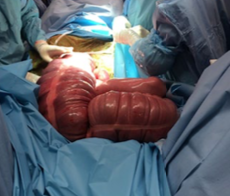 <p>-enteral fluid/laxative is preferred</p><p>-may use IVFs for supportive care or if fluids via NGT not tolerated</p><p>-pain meds (banamine)</p><p>-may need surgery if fails to respond, severe pain, or abnormal ab-tap</p>