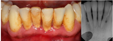 <p>gum disease ; chronic infection of the hard and soft tissue supporting the teeth</p>