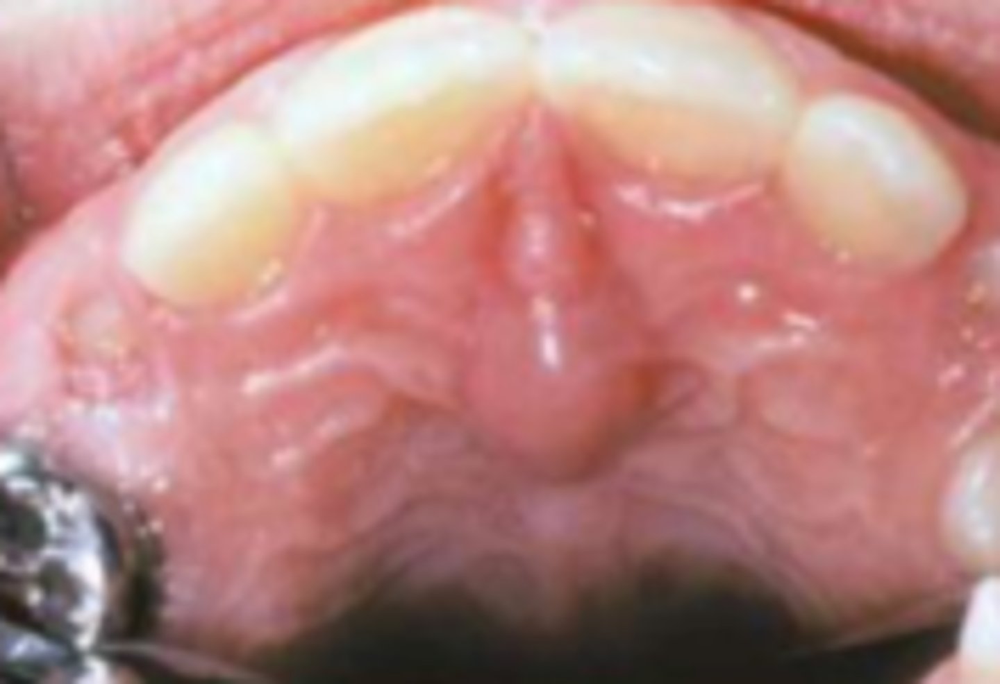 <p>cyst of incisive papilla</p>