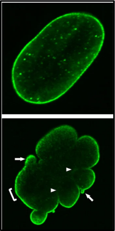 <p>outline LMNA gene (mutation) in HGPS </p>