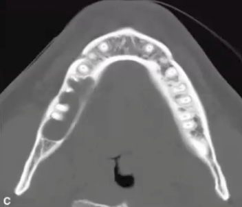 <p>grows mesio distally with relatively<strong> little buccolingua</strong>l expansion in body of mandible (expands in ramus and maxilla)</p>
