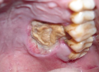 <p>What is the management of anesthetic necrosis?</p>