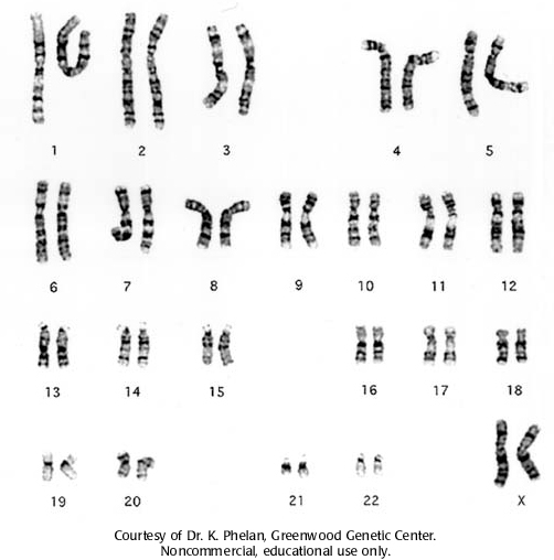 <ol><li><p><strong>Turner syndrome </strong>(XO = monosomy) </p></li><li><p><strong>Klinefelter’s</strong> (XXY = trisomy) </p></li><li><p><strong>Super Female or Triple-X</strong> (XXX = trisomy) </p></li></ol><p></p>