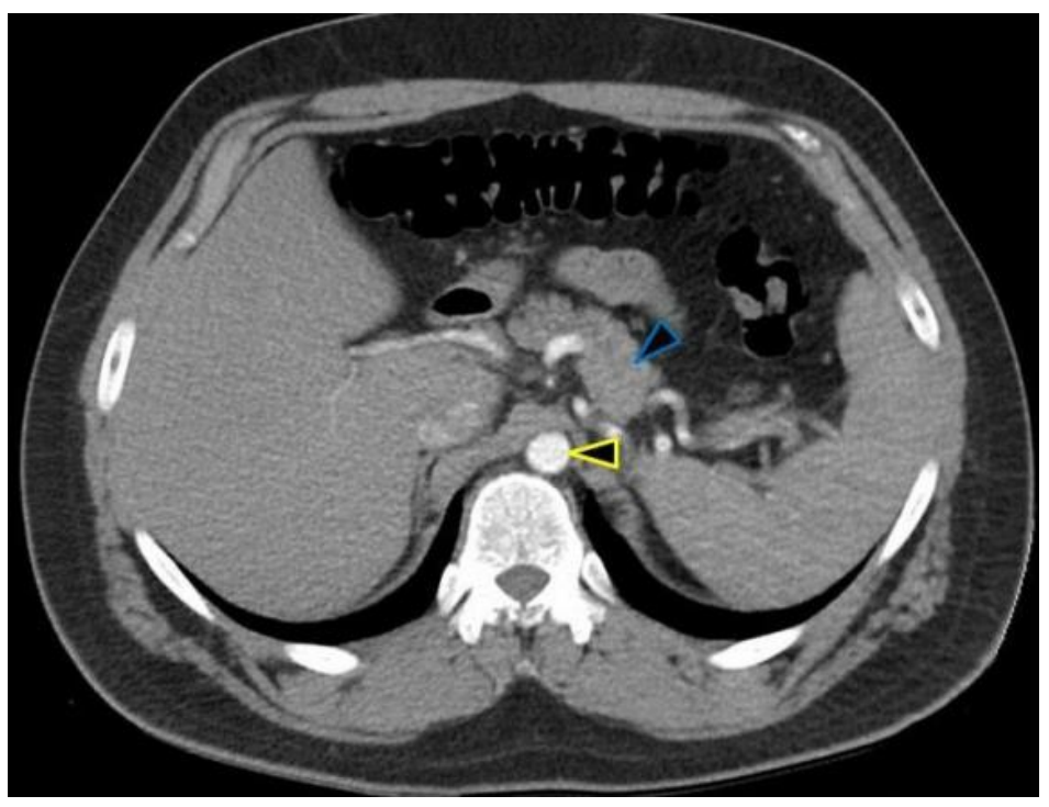 <p>A CT scan from a 55-year-old male reveals the result shown in the accompanying image. Blood supply to the structure indicated by the blue arrowhead is from what artery?</p><p>A. Common hepatic</p><p>B. Left gastric</p><p>C. Proper hepatic</p><p>D. Renal</p><p>E. Splenic</p><p>F. Superior mesenteric</p>