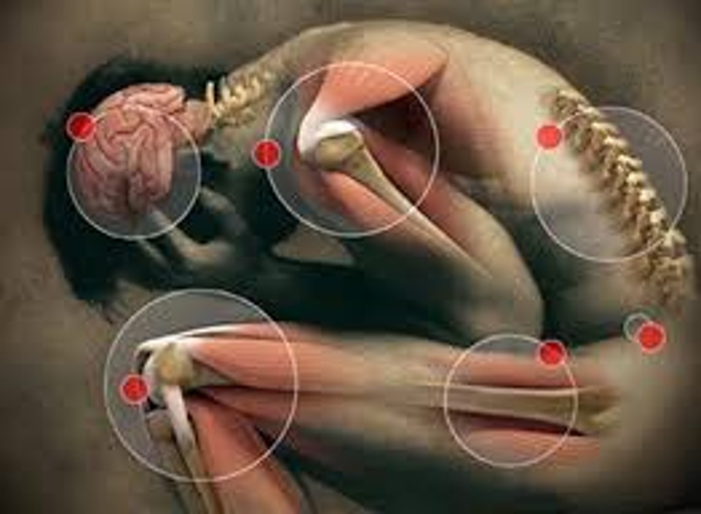 <p>a rare somatoform disorder in which a person experiences very specific genuine physical symptoms for which no physiological basis can be found.</p>
