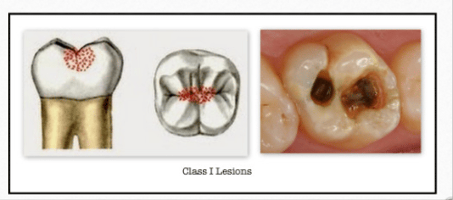 <p>GV Black Classification of Caries:</p><p>- Pits/ fissures on the L surfaces of anteriors and on the occlusal, B &amp; L of posteriors</p>